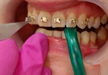 fiksna proteza American orthodontics Iconix