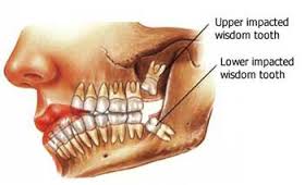 hirurško vađenje zuba