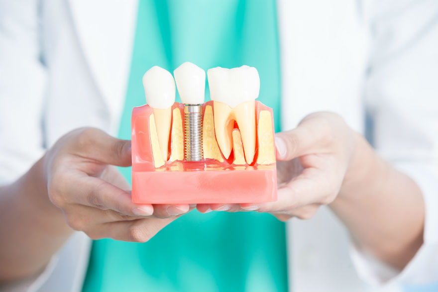 implanti dentalcentar