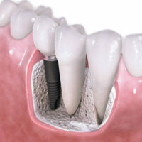 nedostajući zub zamenjen implantom
